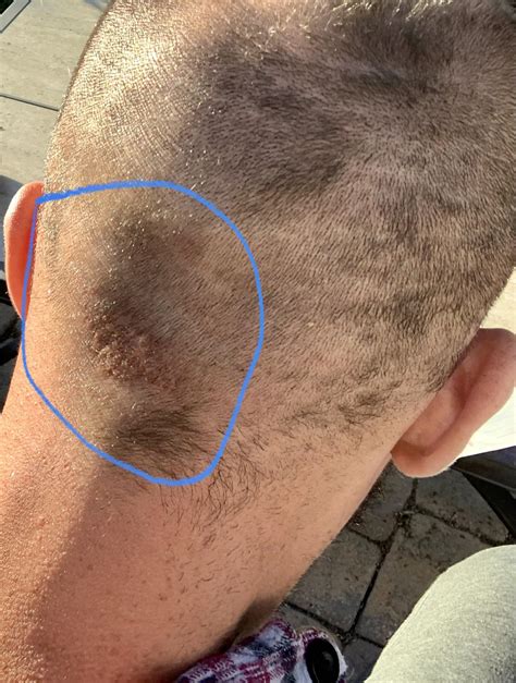 I have a bump on my penis shaft that won't go away. : r/Dermatology