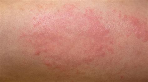 Como Se Ve Una Alergia en La Piel | Bellota Digital