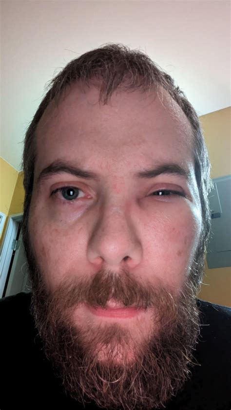 I got a mosquito bite (or spider eggs!) right under my eye. : r/RuinedMyDay