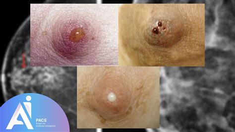 Nipple Discharge Evaluated by Mammography: A Patient's Guide