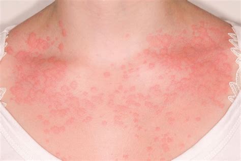 Causes Of Non Itchy Rash On Neck at Noah Stretch blog