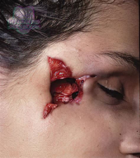 History Of Gunshot Wound Icd at Nate Piquet blog