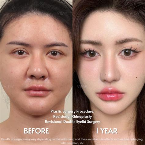 My full face makeover in dream plastic surgery clinic korea before and after surgery – Artofit