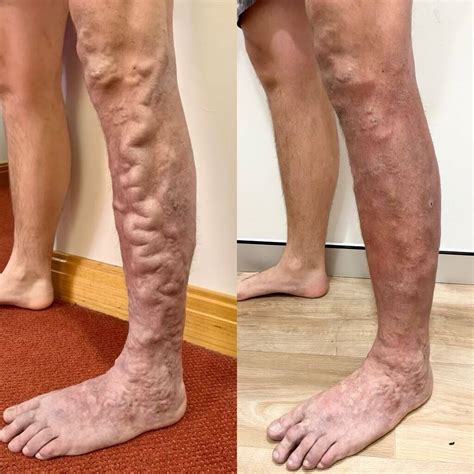 Varicose Veins Case Study