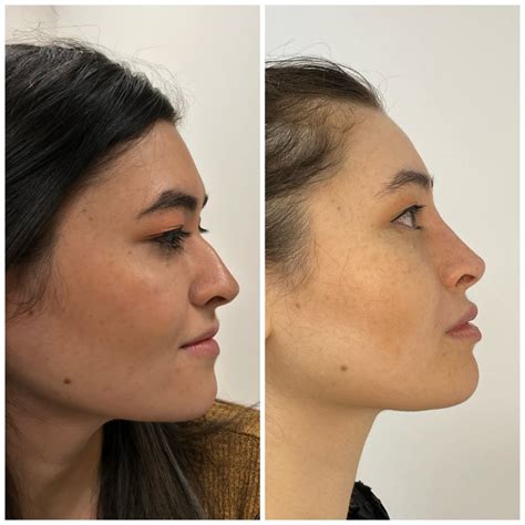 Non Surgical Rhinoplasty/ Nose Filler - Derma Models