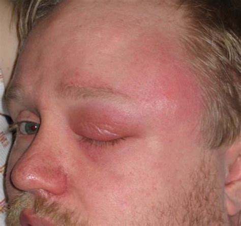 Abscess Tooth Swelling Up To Eye at Kayla Burgess blog