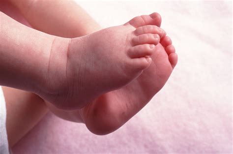 Acrocyanosis In Infants