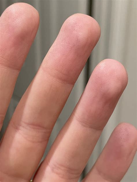 Tiny black spots on fingertips?? : r/Dermatology
