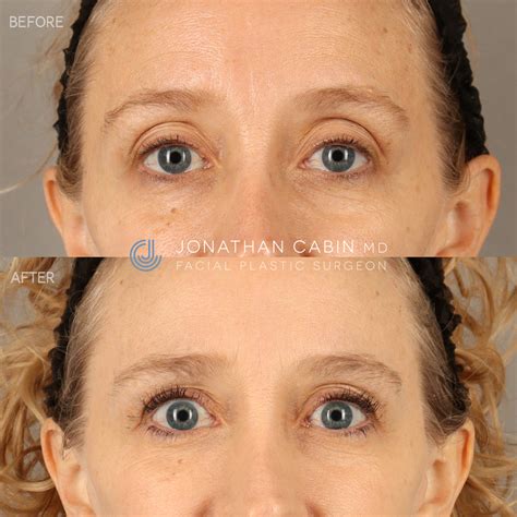 Upper Blepharoplasty with Fat Grafting to the Upper and Lower Eyelids (with Deep Plane Face and ...