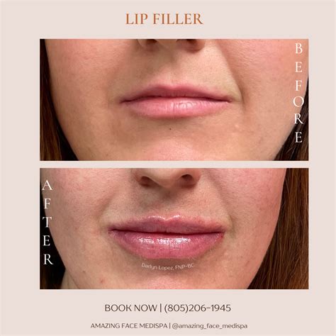 Before & After Aesthetic Injection Xeomin Lip Filler Radiesse Kybella Ultherapy — AMAZING FACE ...