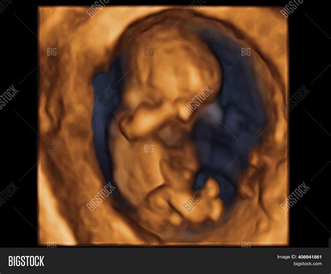 10 Week Fetus Ultrasound 3d