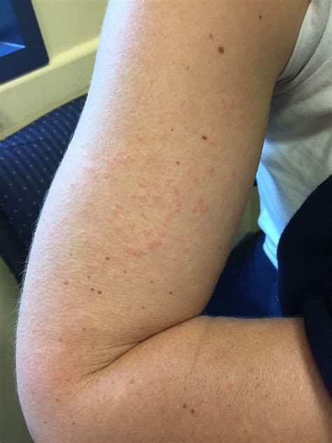 16 Causes of Viral Rashes With Pictures