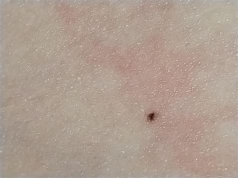 Tiny black dot on upper thigh : r/Melanoma