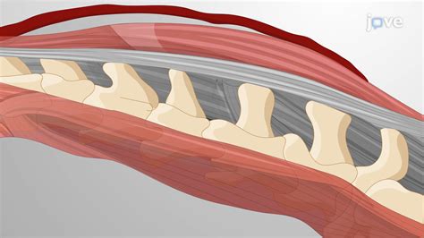 Video: Хирургическая индукция нестабильности поясничного отдела ...