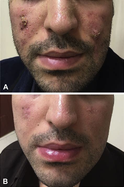 Gram-negative folliculitis caused by Morganella morganii - JAAD Case ...