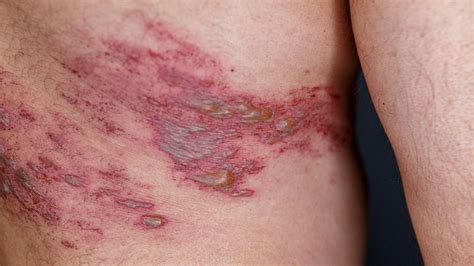 La vacuna contra el herpes zóster podría reducir el riesgo de infarto e ictus