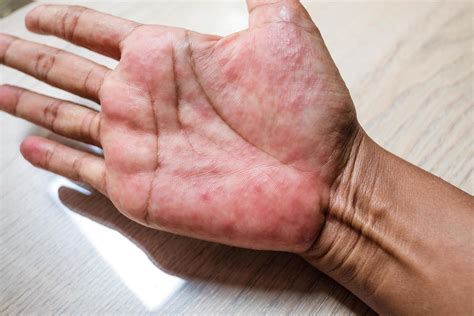Red rash on the hands of the palms ,and other infectious viral diseases in children and adults ...
