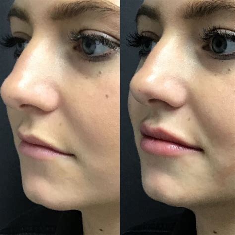 Lip Flip Botox Before And After Photos - Infoupdate.org