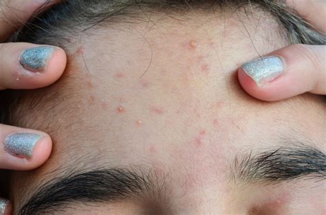 Forehead Acne: Treatments and Prevention