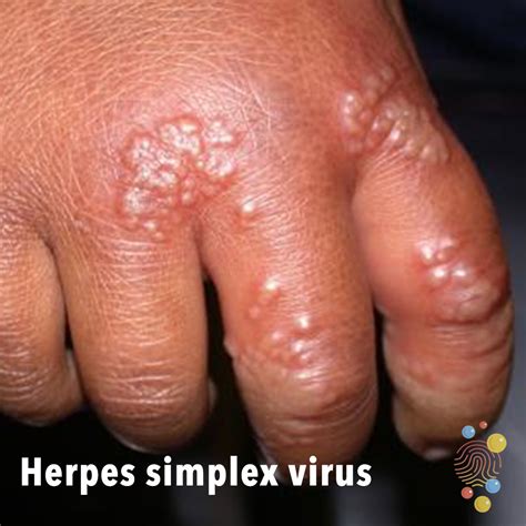 Neonatal dermatology - Don't Forget the Bubbles