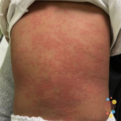 Urticaria Arm Hives: Symptoms, Causes, Prevention And Treatments