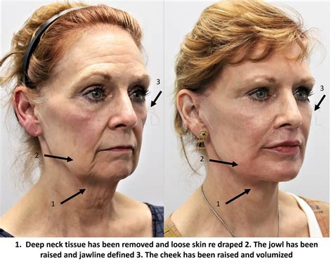 Face Lift Surgery Techniques at Dylan Belstead blog