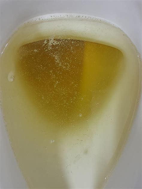 does anybody's pee look like this, if you zoom in you can see some flaky white tissue, its just ...