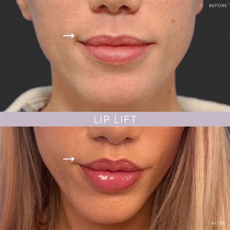 Lip Lift NYC | Lip Specialist New York