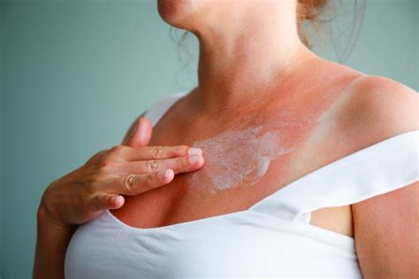 Why Does My Sunburn Itch? Understanding Causes & Relief