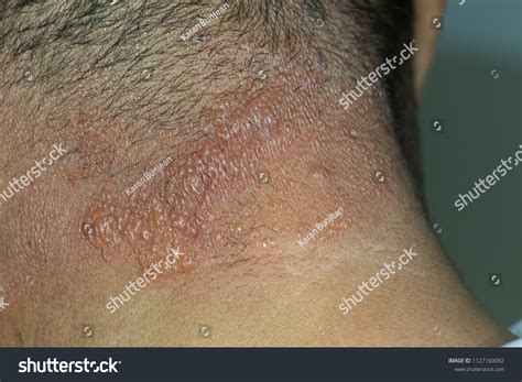 1 Skin Burn Itching Zoom Images, Stock Photos & Vectors | Shutterstock