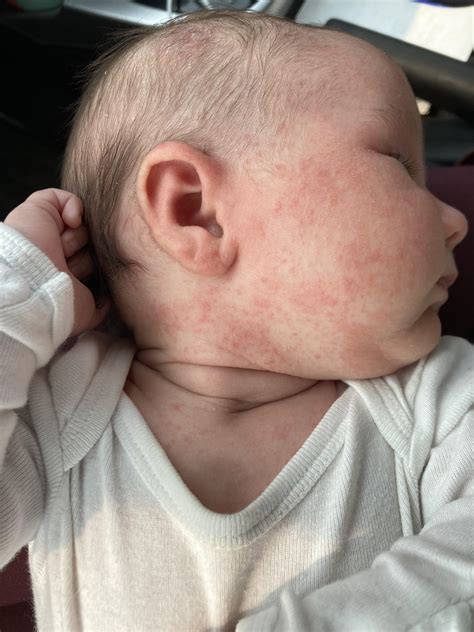 Yeast rash or eczema? : r/newborns