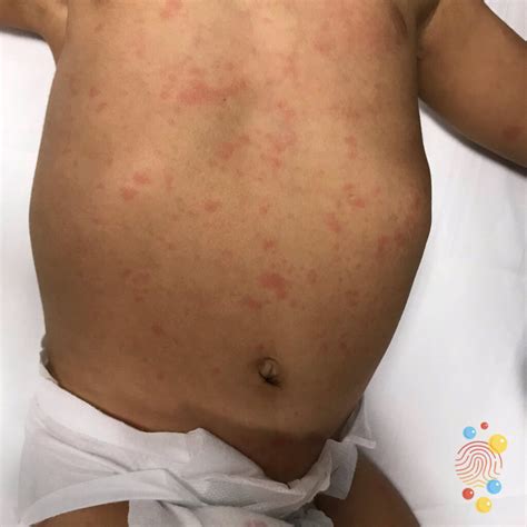 Viral Rash