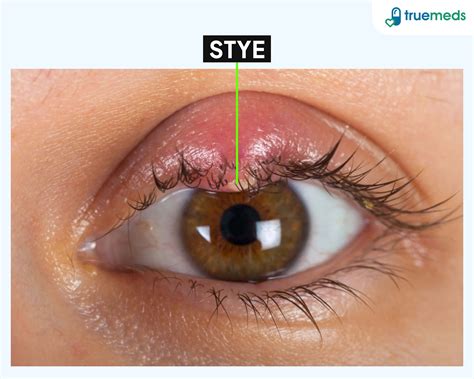 Stye: Causes, Symptoms & Effective Treatment Options