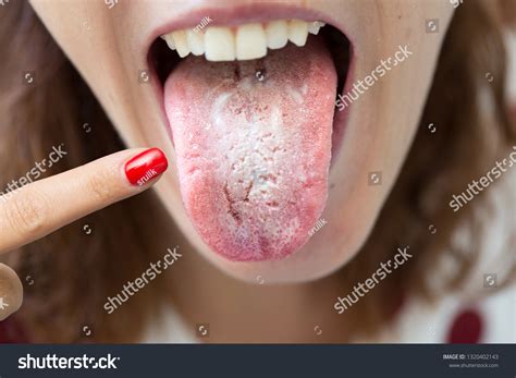 White Coating On Tongue