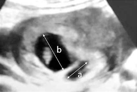 Subchorionic Hematoma Ultrasound Images