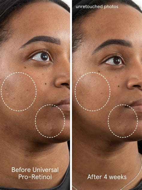 Dark Spots On Face After Using Retinol at Bennie John blog