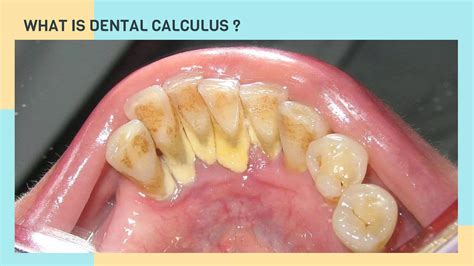 Dental Calculus.pptx