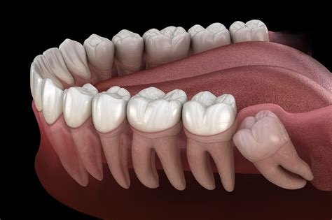 Benefits Of Keeping Wisdom Teeth