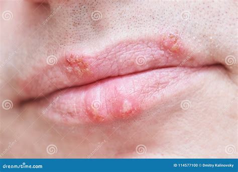 Herpes In Lips Is A Viral Skin Disease Stock Photography ...
