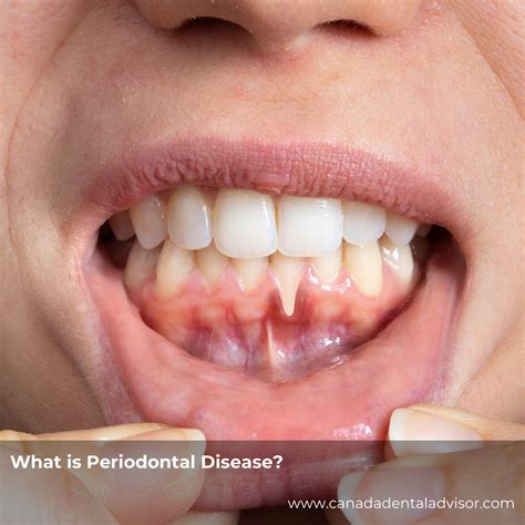 What is Periodontal Disease?
