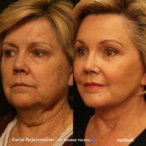 Jowls | Sagging skin face, Face lift surgery, Jowl