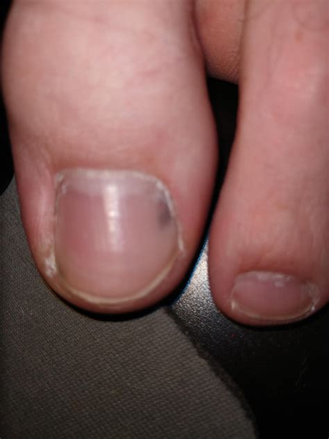 Black spot under toenail + pain and breaking nails. Appeared like 2 weeks ago. Should i be ...