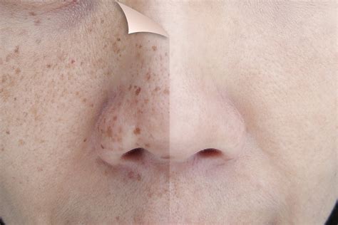 When To Be Concerned About Dark Spots On Face