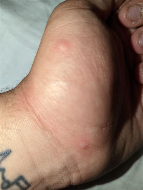 are these yellow fly bites or no see um bites : r/florida