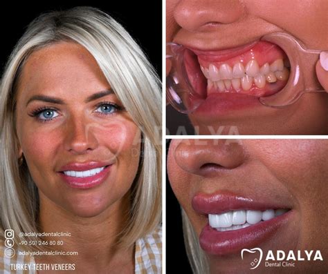 Turkey Teeth Veneers - Affordable Dental Veneer Price in Antalya