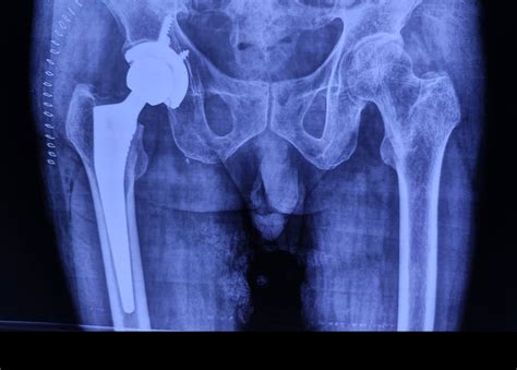 Hip Fractures Surgery in Ahmedabad | Dr. Rachit Sheth