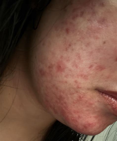 1 best u/poliwagyu88 images on Pholder | damaged skin barrier, hormonal acne, rosacea, sensitive ...