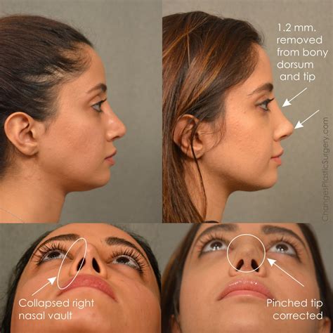 Nose Job Examples at Michele Wenz blog