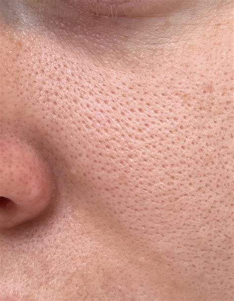 I’ve always been grossed out by large pores, is there anything I can do or is it a lost cause ...