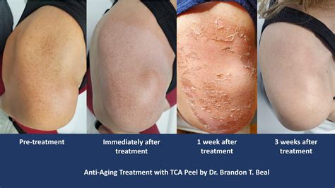 Chemical Peel St. Louis – Chemical Peel for Brown Spots and Facial Fine Lines and Wrinkles